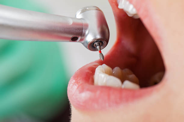 Best Broken or Chipped Tooth Repair in Hartshorne, OK